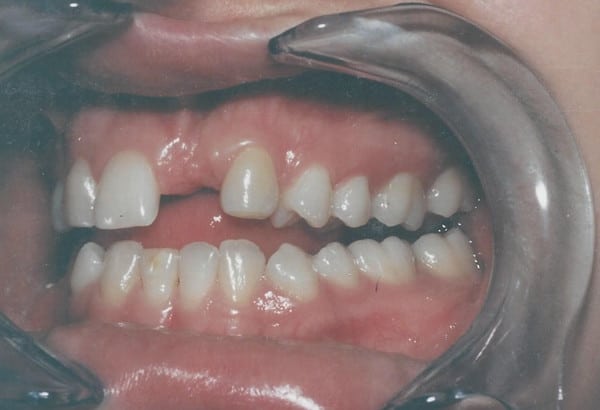 Before Image: Crowns & Bridges - front