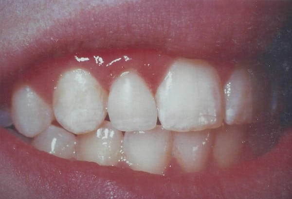 After Image: Lateral Veneers - other