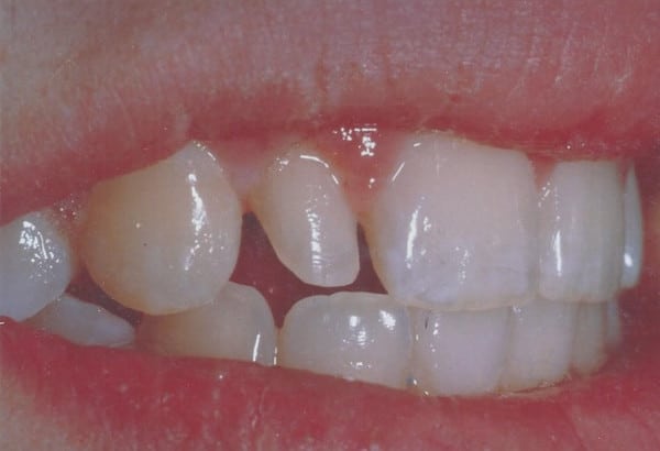 Before Image: Lateral Veneers - other