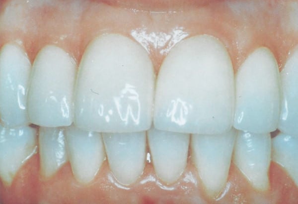 After Image: Porcelain Veneers - other
