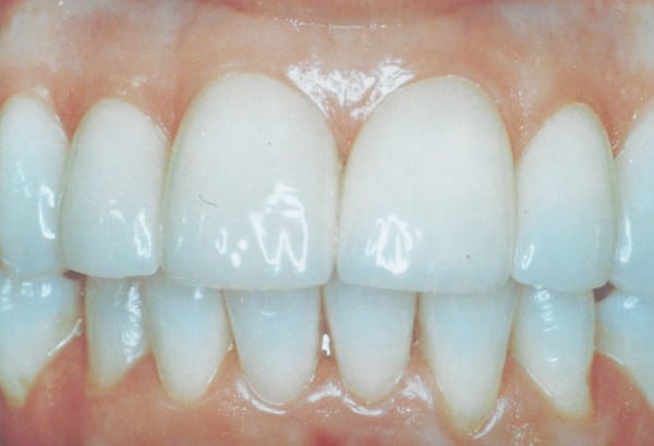 Porcelain Veneers