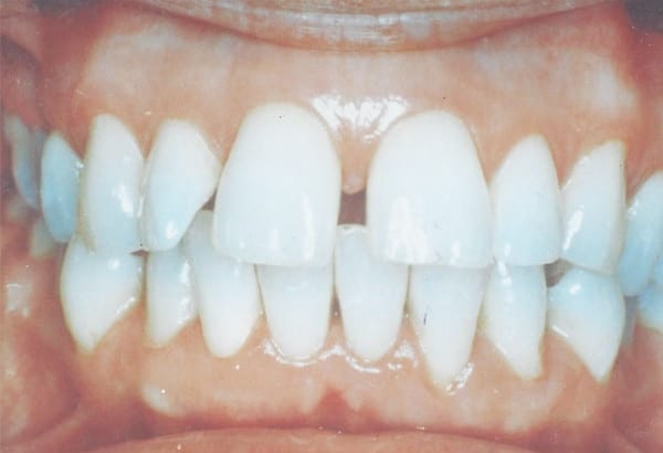 Before Image: Porcelain Veneers - other