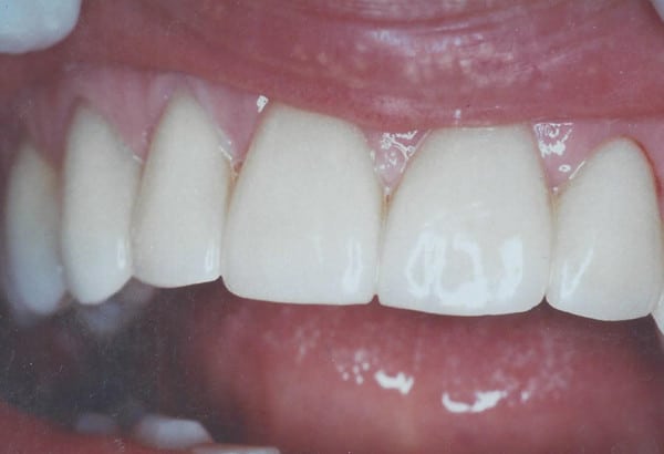 Porcelain Veneers