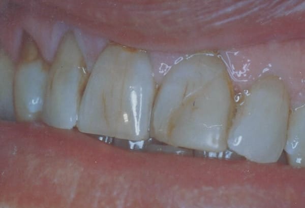 Before Image: Porcelain Veneers - other