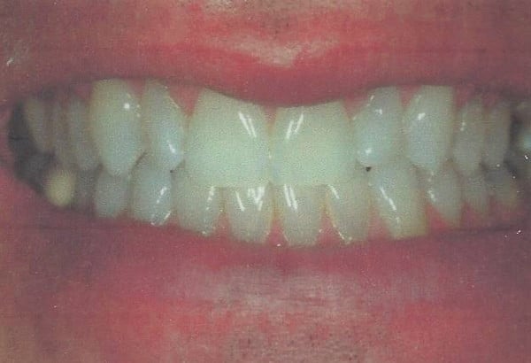 After Image: Invisalign