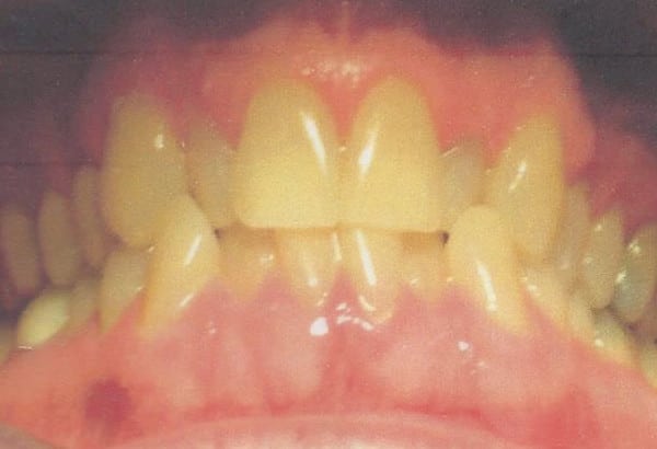 Before Image: Invisalign