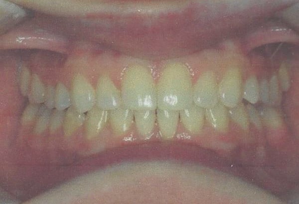 After Image: Invisalign