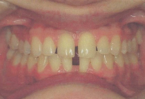 Before Image: Invisalign
