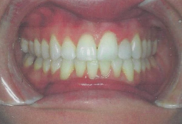After Image: Invisalign