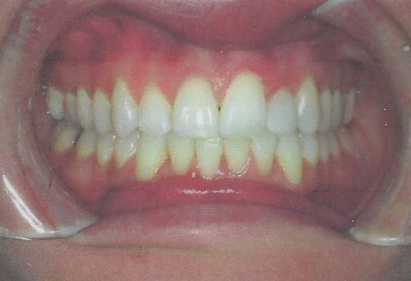 Invisalign