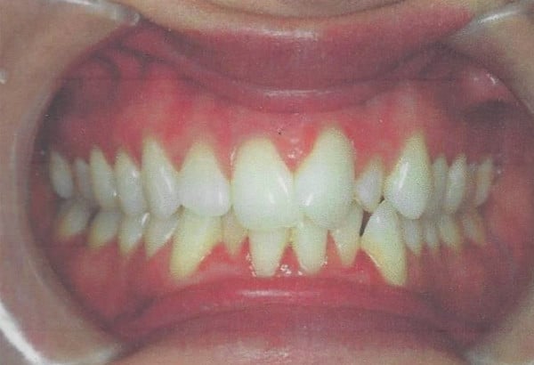 Before Image: Invisalign