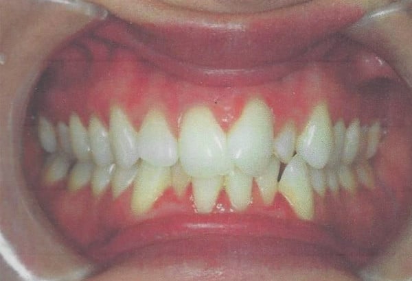 Invisalign